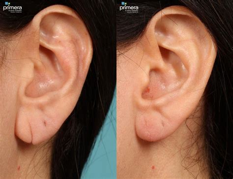 Ear Surgery Otoplasty Before And After Photos Patient 424 Orlando