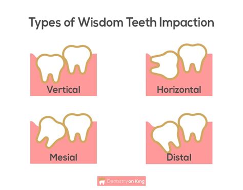 Wisdom Teeth Removal In Toronto Dr Alavi Dentistry On King