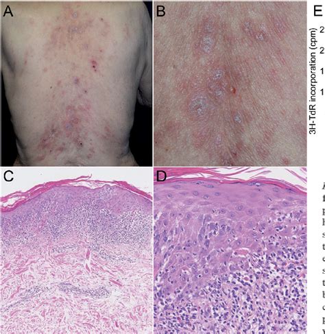 Figure 1 From A Skin Biopsy From A Scaly Erythematous Lichenoid Drug