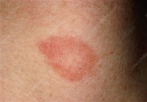 Minor Ringworm Infection On Womans Neck Stock Image M2700019