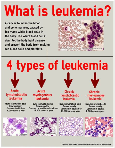 Understanding Leukemia Chart 20x26 Leukemia Medical K