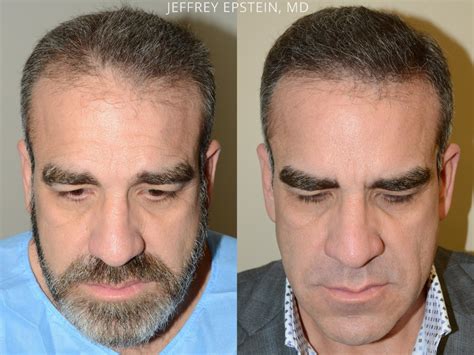Hair Transplants For Men Photos Miami Fl Patient54176