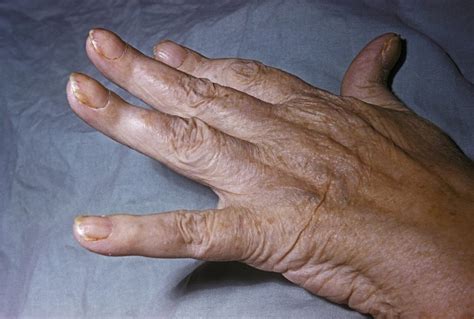Screening Tool Identifies Psoriatic Arthritis In Patients With