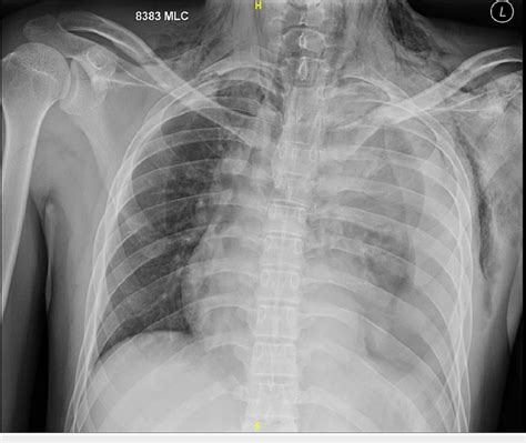 Chest X Ray Showing Left Sided Hemo Thorax With Left Clavicle Left