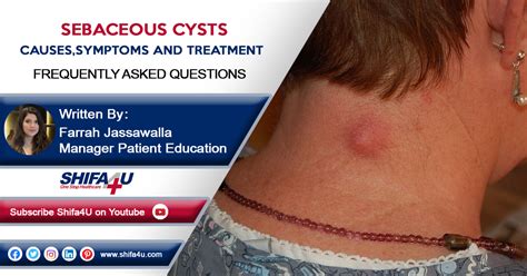 Sebaceous Cysts Symptoms Causes And Treatment Skinkraft Images And Photos Finder