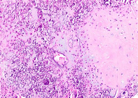 Pathology Outlines Chondroblastoma
