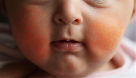 Slapped Cheek Syndrome This Childhood Condition Causes Red Cheeks Goodto