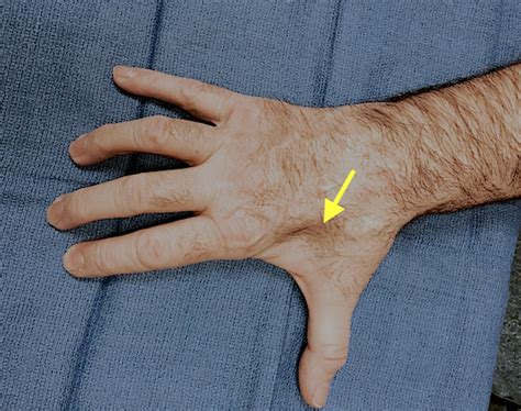 Ulnar Intrinsic Atrophy Hand Surgery Resource