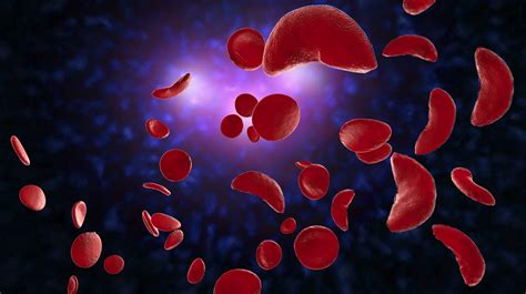 Sickle Cell Anemia Causes Symptoms And Treatment Options