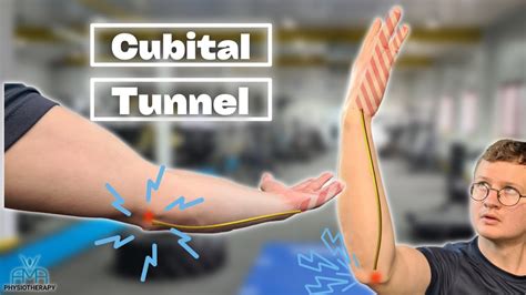 Best Cubital Tunnel Syndrome Exercises Posture Exercises Method