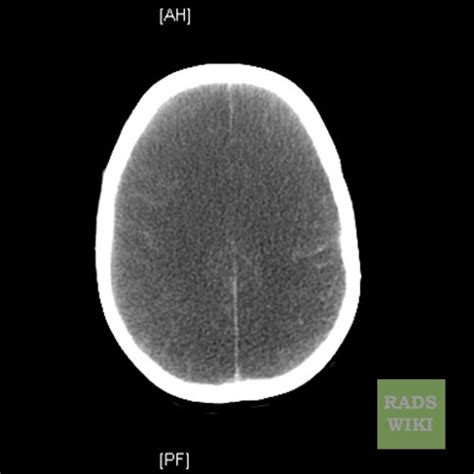 Anoxic Brain Injury Ct Wikidoc