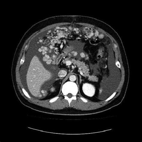 A Ct Scan Of The Abdomen Shows Multiple Nodules In The Omentum With A