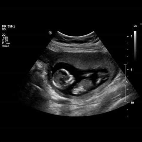 14 ssw schwangerschaftswoche größe entwicklung and mehr