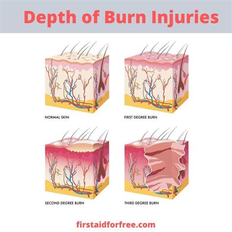 An Overview Of The Classification Of Burn Injury Depths⠀ ⠀ Burns