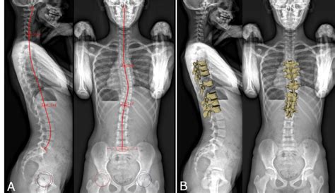 A Manual Initialization Of The 3d Reconstruction The Sacral Plate