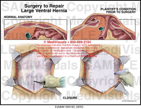 Medivisuals Surgery To Repair Large Ventral Hernia Medical Illustration