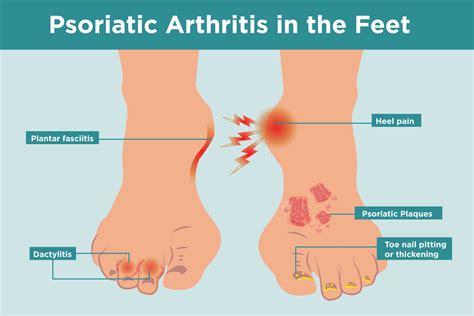Psoriatic Arthritis In The Feet Symptoms Treatment Home