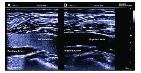 Ultrasound Imaging Of The Popliteal Vein A The Flow Is