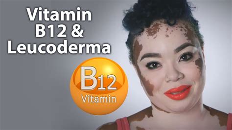 It can also come on relatively quickly. Vitamin B12 & White Patches/Leucoderma - YouTube
