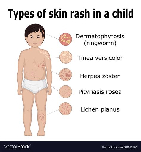 Types Skin Rash In A Child Royalty Free Vector Image