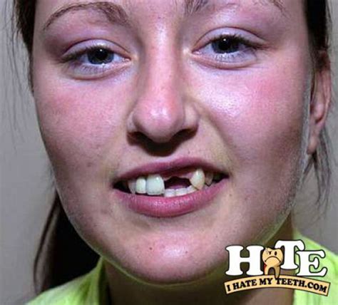 The Worst Teeth Ever 31 Pics