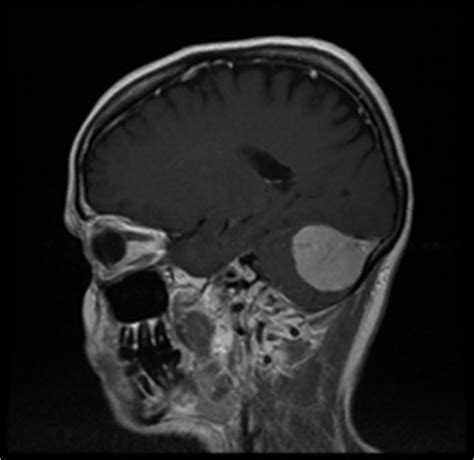 Von rumpere ,reißen') bezeichnet in der medizin die zerreißung oder den riss eines inneren organs, eines muskels, eines gefäßes, eines bandes oder einer sehne. MRT Kernspintomographie
