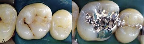 9 Direct Composite Restorations Pocket Dentistry