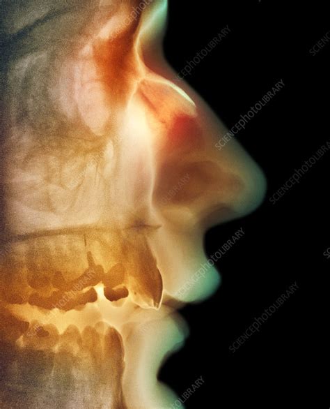 Broken Nose X Ray Stock Image M3301099 Science Photo Library