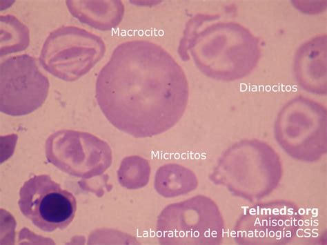 Fichero De Hematologia Anisocitosis