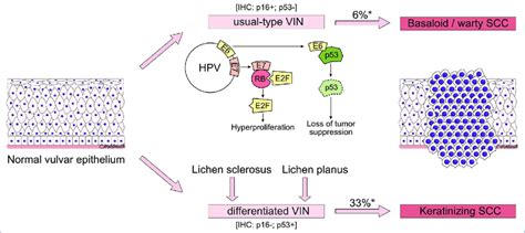 Pathophysiology Of Usual Type And Differentiated Vin And Its
