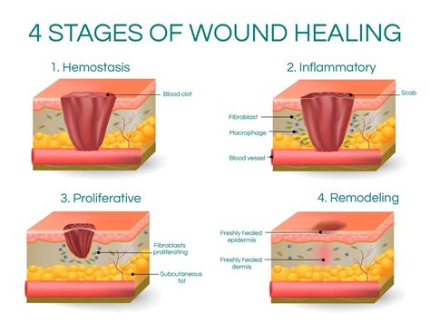 What Are The Different Stages Of Wound Healing Best Design Idea
