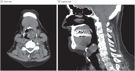 A Rare Cause Of Oropharyngeal And Supraglottic Airway Narrowing