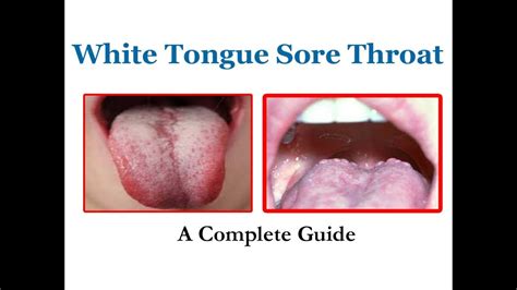 Strep Throat Bumps On Tongue Exurt