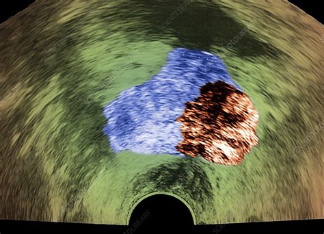 Prostate Cancer Ultrasound Scan Stock Image C0343237 Science