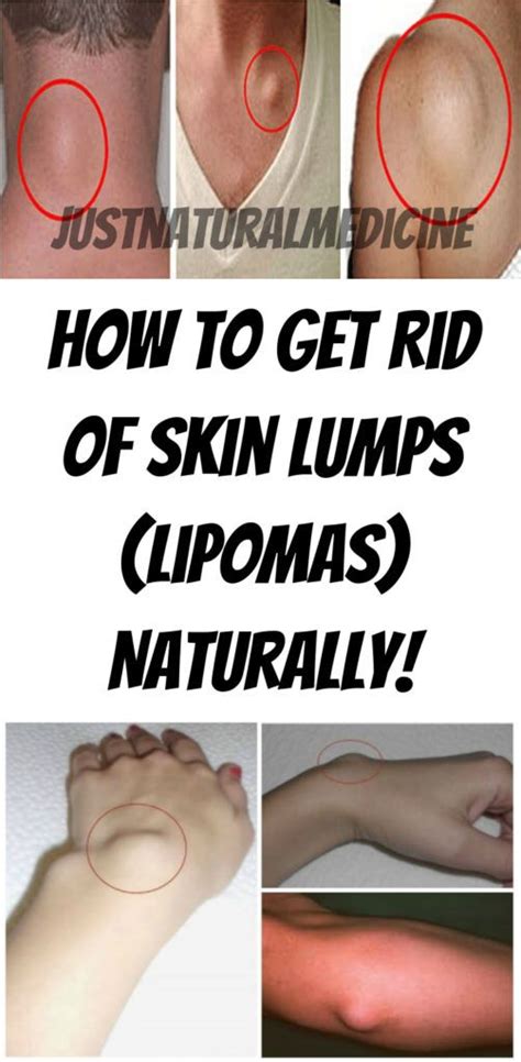 How To Get Rid Of Skin Lumps Lipomas Naturally Just Natural
