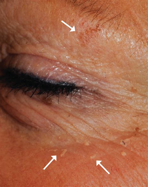 What Is The Cause Of These Lesions On A Womans Eyelid Consultant360
