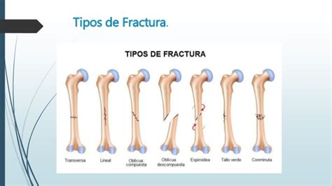 Presentación Fractura De Tibia Y Perone