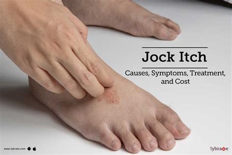Jock Itch Treatment Procedure Cost Recovery Side Effects And More