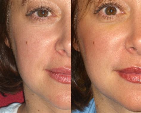 Before And After Pictures Surface Medical Spas