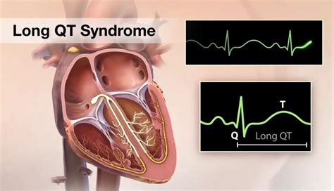 Fatal Arrhythmia Is The Leading Cause Of Mortality In Chronic
