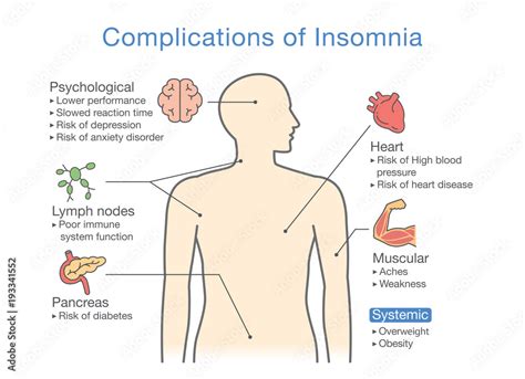 Diagram Of Complications Of Insomnia Llustration About Effects Of Health Problem Stock Vector