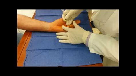 Percutaneous Fasciotomy For Dupuytrens Contracture Youtube