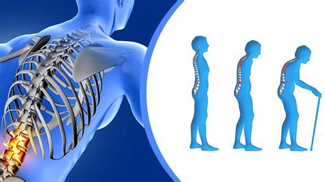 Osteoporoza Simptome Cauze Si Tratament Boala Crohn S N Tate I The