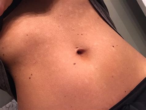 K Spots On Stomach Tampa Bay Tan