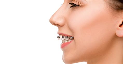 How Do Braces Fix Overbites Premier Orthodontics