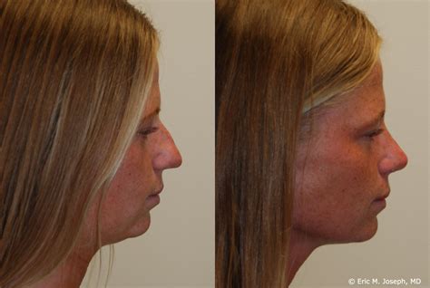 Eric M Joseph Md Rhinoplasty Before And After Deviated Septum Correction