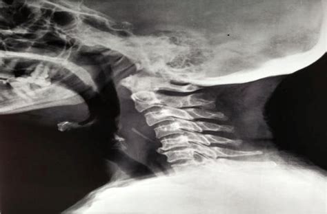 X Ray Soft Tissue Neck Lateral View Revealing A Fb At C4 Level With