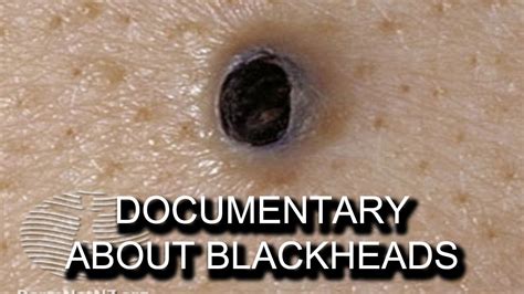 Blackhead Blackheads And More Black Heads Documentary Youtube