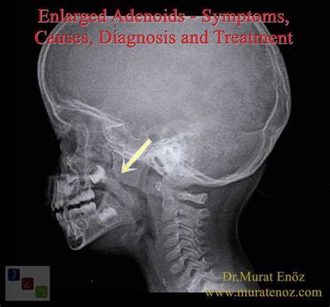 Enlarged Adenoids Symptoms Causes Diagnosis And Treatment