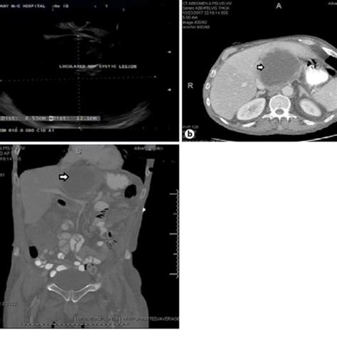 Fungating Mass In Esophagus Seen On Endoscopy With Suspected Fistula